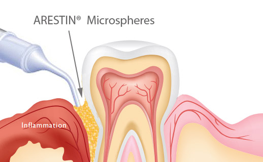 Arestin Treatment Process